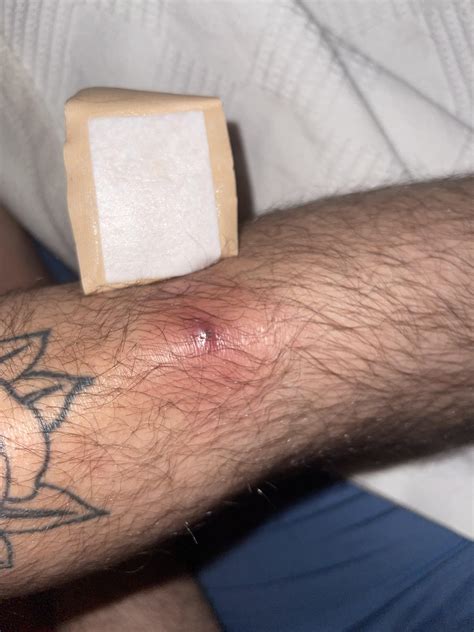 Antibiotics For Spider Bite