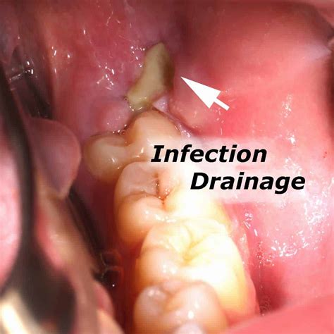 Wisdom Teeth Infection Before Removal Wisdom Teeth Surgery Your