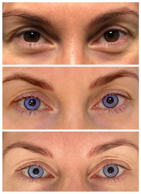 Results and Examples — Eye Color Change — KERATO
