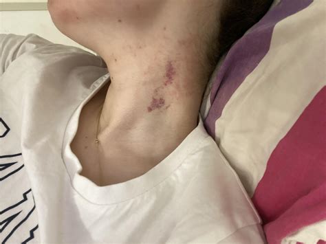 I bruised my neck pretty badly and I have a MRA of the neck for other ...