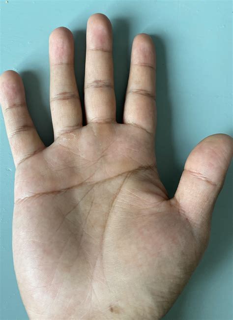 Simian Crease Down Syndrome Internet Scientific Publications