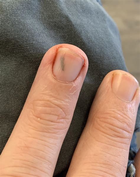 Splinter Under Fingernail