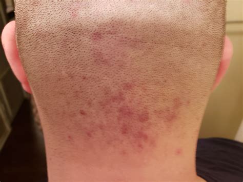 Fungal Folliculitis Neck