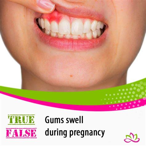 Swollen Gums During Pregnancy