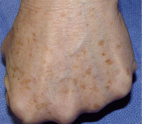 Brown Spots On Back Of Arm at Mary Bevis blog
