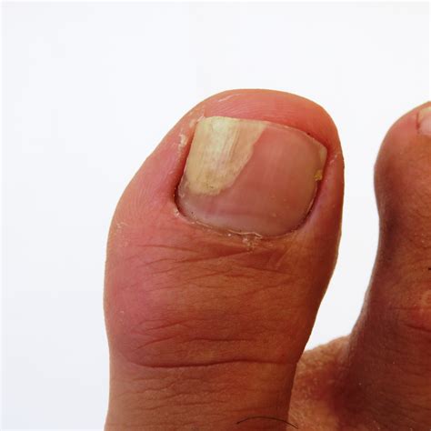 Toe Fungus
