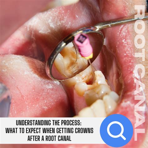 Understanding the Process: What to Expect When Getting Crowns After a Root Canal | Bright Smile ...