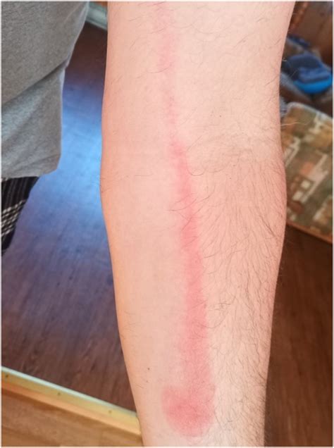 Tolerance of penicillin V in patients with confirmed delayed ...