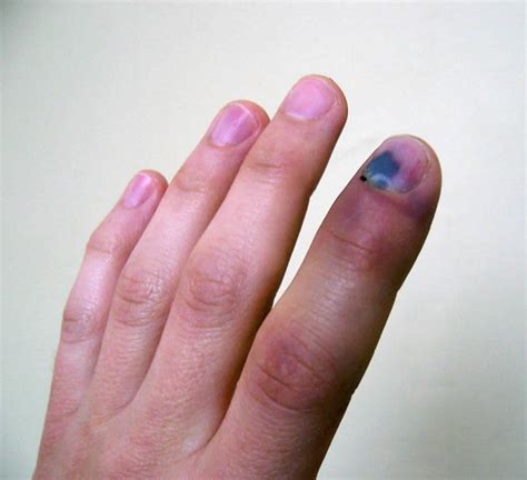 Smashed Finger Swelling And Purple