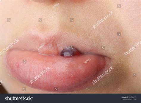 108件の「Blood blister in mouth」の画像、写真素材、ベクター画像 | Shutterstock