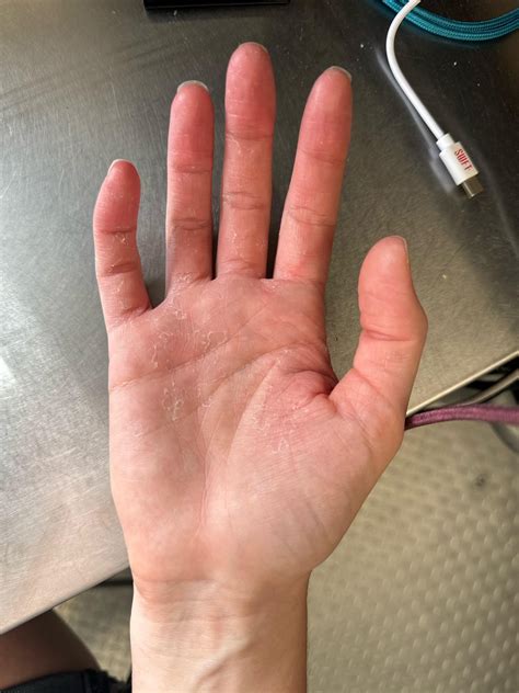 Extreme dry/cracking skin : r/DermatologyQuestions