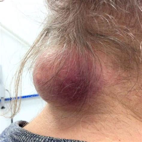 Do You Need Anaesthetic for Lipoma Removal? Everything Explained