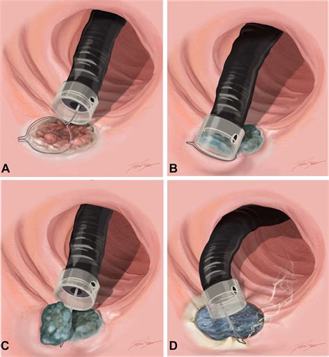 Removing inflammatory bowel disease-associated dysplastic lesions with ...