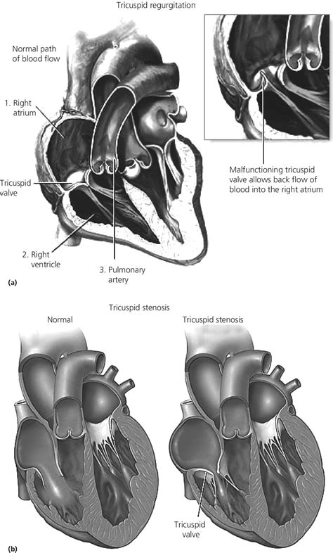 13: The tricuspid valve | Thoracic Key