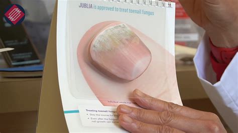 Foot Doctor Explains Treatments for Toenail Fungus — AAMG Doctors
