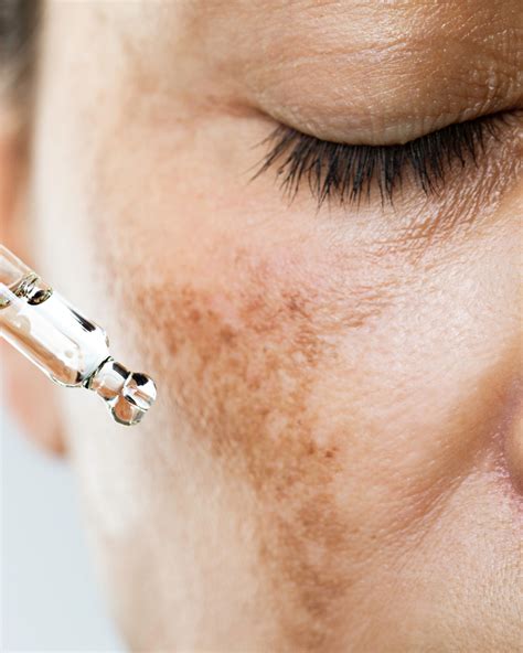 How to treat Melasma effectively - Dr Sophie Shotter