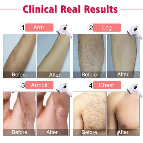 Laser Hair Removal Before And After Bikini