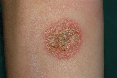 Tema 09. DERMATITIS ATÓPICA Y OTROS ECZEMAS - Dermatopharm