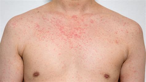 Texas measles cases surpass 100: See map of states with infections