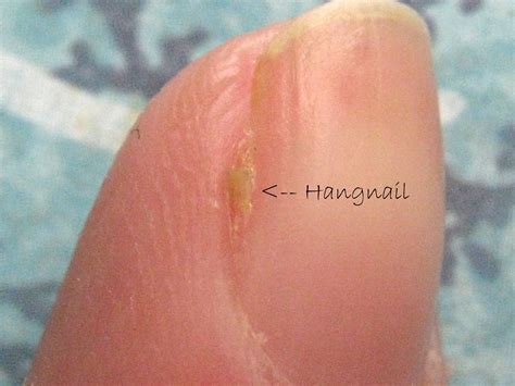 Pulled Hangnail Pain Relief at Ronald Wray blog