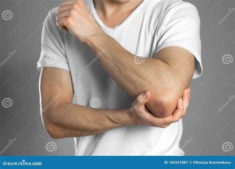The Bruise on the Elbow. Pain in the Elbow. the Man Holds His Hand ...
