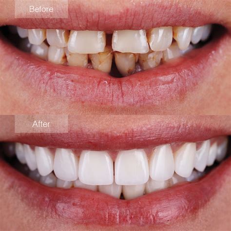 Porcelain Veneers Before and After - The Dental Room