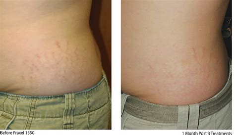 What Is A Stretch Mark Medical Term at Bailey Walters blog