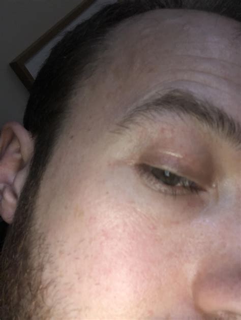 Pain In Outer Corner Of Eye | Renew Physical Therapy