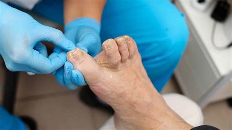 When to See a Doctor for Ingrown Toenail? Pro Foot Doctors