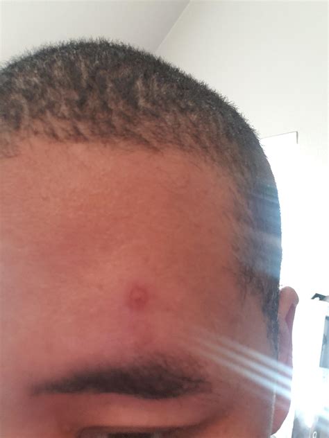 hard painful bump on forehead : r/acne