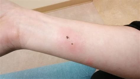 Woman hospitalized after Brown Recluse spider bite | kvue.com