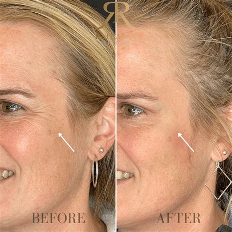 Crowsfeet Treatment Before and After Images | Bothell, WA