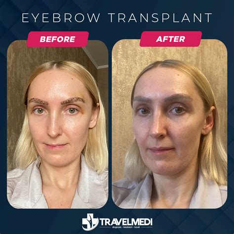 Collection 93+ Pictures Eyebrow Transplant Before And After Photos Sharp
