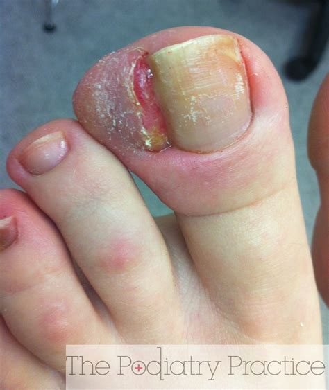 Worst Ingrown Toenail