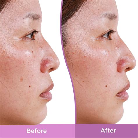 Differin Dark Spot Correcting Serum Review - Clearer Skin