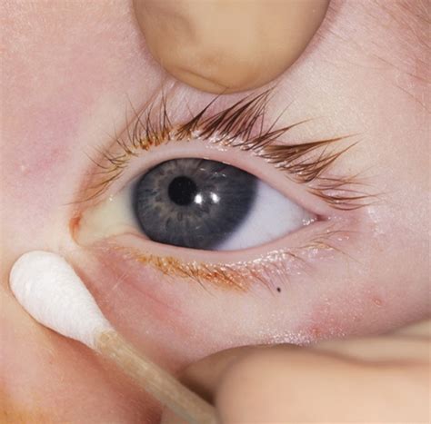 Full article: Congenital Nasolacrimal Duct Obstruction - Early ...