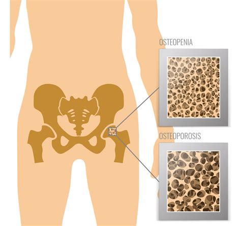 Osteopenia Que Es