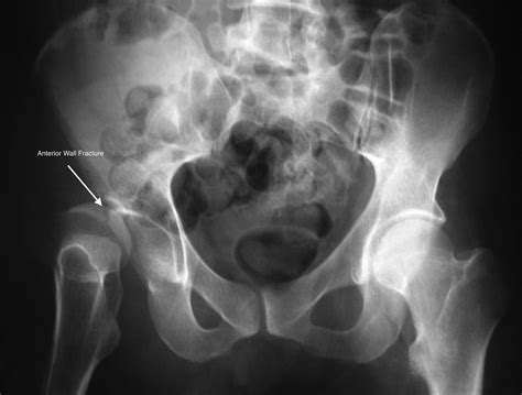 What Is A Posterior Wall Acetabular Fracture at Eva Dolling blog