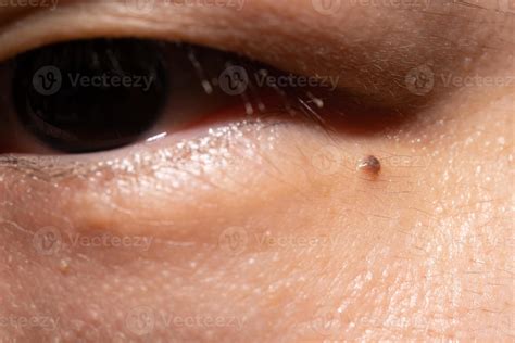 mole under the eyes of a man, pigmentation on the face 8902289 Stock ...