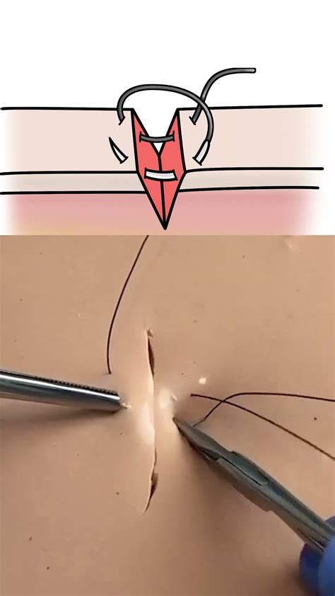 Figure of 8 Suture - YouTube