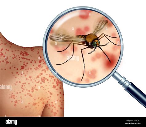 Infected insect bites hi-res stock photography and images - Alamy