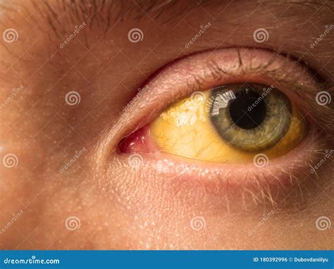 407 Eye Sclera Stock Photos - Free & Royalty-Free Stock Photos from ...