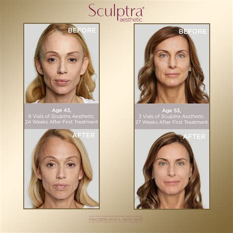 Sculptra available at Dermalogic
