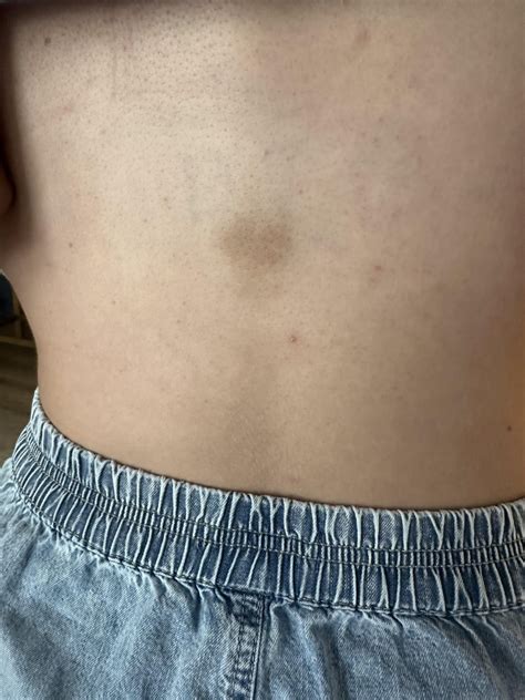 Bruise/ hyperpigmentation on spine : r/DermatologyQuestions