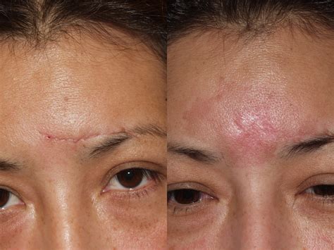 Before & After Pictures | Scar Revision Chicago, IL |Dr. Sidle