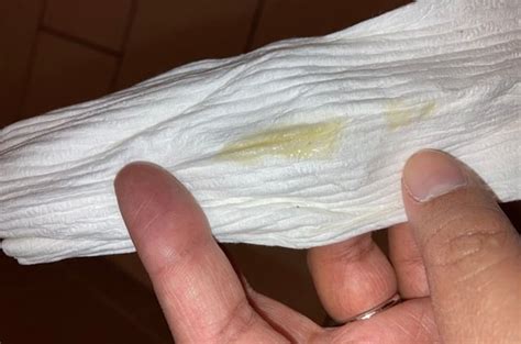 How to Treat a Yellow Yeast Infection: Understanding Symptoms and ...