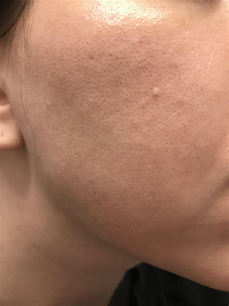 Small White Pimple On Face