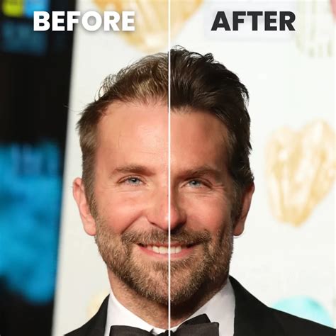 Bradley Cooper Hair Transplant | Amazing Results 2024