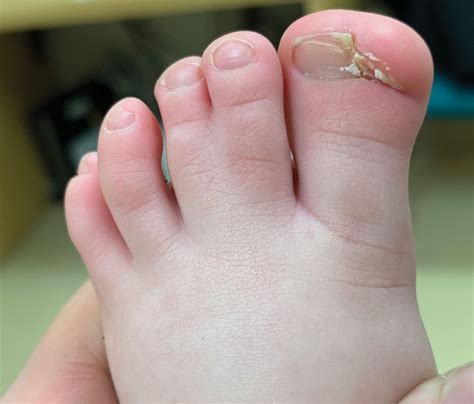 Congenital Defect of the Toenail | MDedge