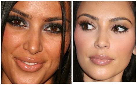 Kim Kardashian Face Surgery